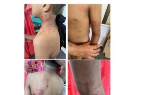 ಬೀದಿ ನಾಯಿಗಳ ದಾಳಿ: ಬಾಲಕನಿಗೆ ಗಾಯ