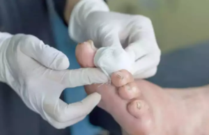 ಮಧುಮೇಹದಲ್ಲಿ ಕಾಡುವ ಪಾದದ ಹುಣ್ಣಿನ ನಿಯಂತ್ರಣಕ್ಕೆ ಇಲ್ಲಿದೆ ಪರಿಹಾರ