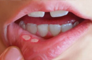 ಬಾಯಿ ಹುಣ್ಣು ನಿವಾರಣೆಗೆ ಸಿಂಪಲ್ ಮನೆಮದ್ದು