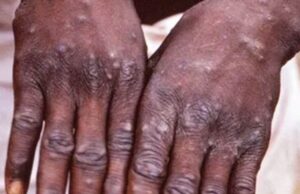 ದೇಶಕ್ಕೆ ಕಾಲಿಟ್ಟ ಮಂಕಿಪಾಕ್ಸ್: ಕೇರಳದಲ್ಲಿ ಮೊದಲ ಪ್ರಕರಣ