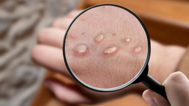 monkeypox16592096061659248107