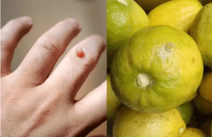 ನರಹುಲಿ ಸಮಸ್ಯೆಗೆ ನಿಂಬೆರಸ ಬಳಸಿ ನೋಡಿ