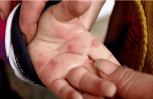 ಕೇರಳದಲ್ಲಿ ಟೊಮೇಟೊ ಜ್ವರ: ರಾಜ್ಯದಲ್ಲಿ ಹೈ ಅಲರ್ಟ್