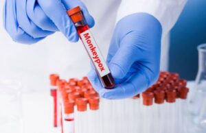 ದೆಹಲಿಯಲ್ಲಿ ಐದನೇ ಮಂಕಿಪಾಕ್ಸ್ ಪ್ರಕರಣ ಪತ್ತೆ