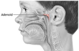 ಎಡಿನಾಯಿಡ್ಸ್