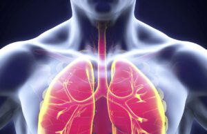 ನ್ಯುಮೋನಿಯಾ