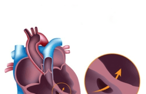 ವೆಂಟ್ರಿಕ್ಯುಲರ್ ಸೆಪ್ಟಲ್ ಡಿಫೆಕ್ಟ್(ವಿ.ಎಸ್.ಡಿ)