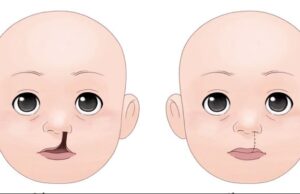 ಸೀಳು ತುಟಿ (ಕ್ಲೆಪ್ಟ್ ಲಿಪ್)