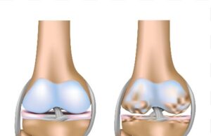 ಸಂಧಿವಾತ