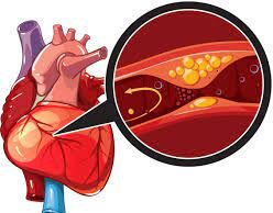 ದಮನಿರ ವ್ಯಾಧಿ (ಕರೋನರಿ)(Coronary Artery Disease)