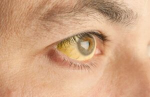 ಅರಿಶಿಣ ಕಾಮಾಲೆ (ಜಾಂಡೀಸ್)