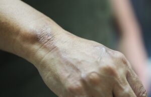 ಕುಷ್ಠರೋಗ