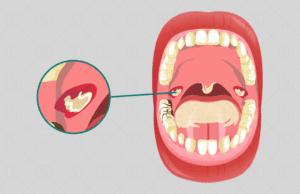 ಎಳೆನಾಗರು ಡಿಫ್ತೀರಿಯಾ