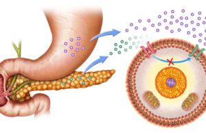 ಕೀಟೋ ಅಸಿಡೋಸಿಸ್: ಭಾಗ-3