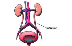 ಮೂತ್ರದಲ್ಲಿ ಉರಿ : ಭಾಗ ಒಂದು