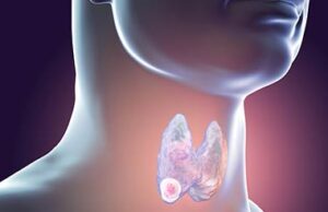 ಕ್ಯಾನ್ಸರ್