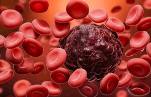 ಬ್ಲಡ್ ಕ್ಯಾನ್ಸರ್