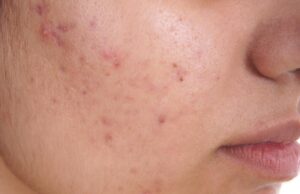 ಮೊಡವೆ ಗುಳ್ಳೆಗಳು