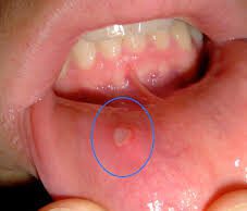 ಬಾಯಿ ಹುಣ್ಣು