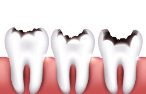 ಹಲ್ಲಿನ ಮೇಲೆ ಕರೆಕಟ್ಟುವುದನ್ನು ತಡೆಯಲು ಚಿಕಿತ್ಸೆ