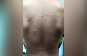 ಕಡಬದ ಮಕ್ಕಳಲ್ಲಿ ಚಿಕನ್ ಪಾಕ್ಸ್: 15 ಮಕ್ಕಳಲ್ಲಿ ಸೋಂಕು ದೃಢ