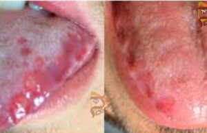 ನಾಲಿಗೆಯಲ್ಲಿ ಹುಣ್ಣಾಗುವುದು ಗಂಭೀರ ರೋಗ ಬರುವ ಮುನ್ಸೂಚನೆಯೇ..?