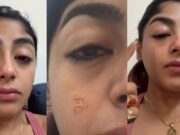 ಕ್ಲಬ್ನಲ್ಲಿ ರಿಯಾಲಿಟಿ ಶೋ ಸ್ಪರ್ಧಿಗೆ ಗಂಭೀರ ಗಾಯ:ಹಲ್ಲು ಮುರಿದು ಮುಖ ಊದಿದ ಸ್ಥಿತಿಯಲ್ಲಿ ಪ್ರೀತ್ ಸಿಂಗ್